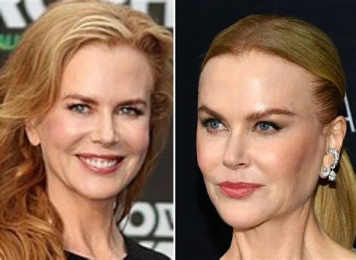 Nicole Kidman Surgery: A Closer Look At The Hollywood Star's Transformation